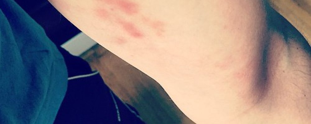 A break from the usual skylines to bring you trapeze bruises in their first blush.