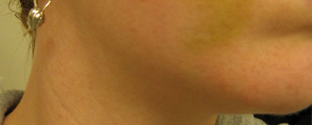 Bruise Still There...
