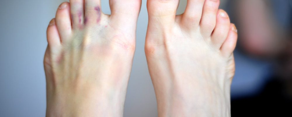 Rainbow Bruise